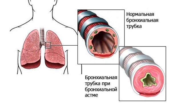 Изменения в бронхах