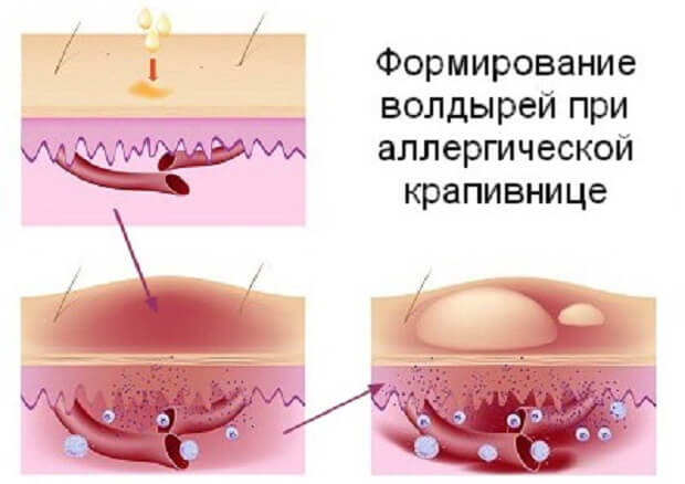 Формирование волдырей