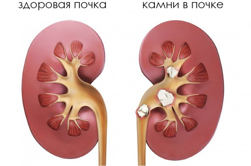 Мочекаменная болезнь