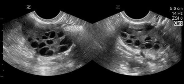 Поликистоз яичников на снимке УЗИ