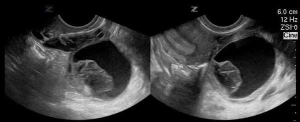 Как выглядит дермоидная киста яичника на снимке УЗИ