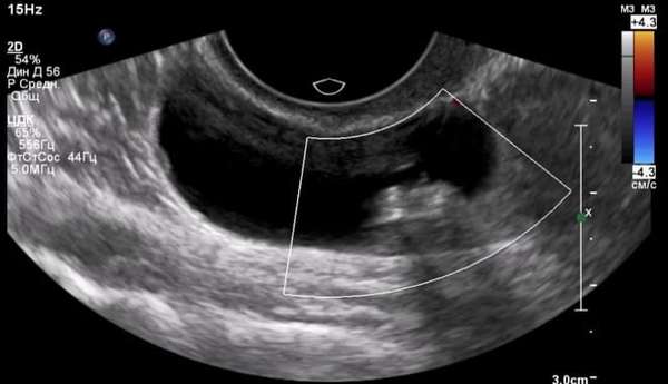 Как выглядит серозная цистаденома яичника на снимке УЗИ