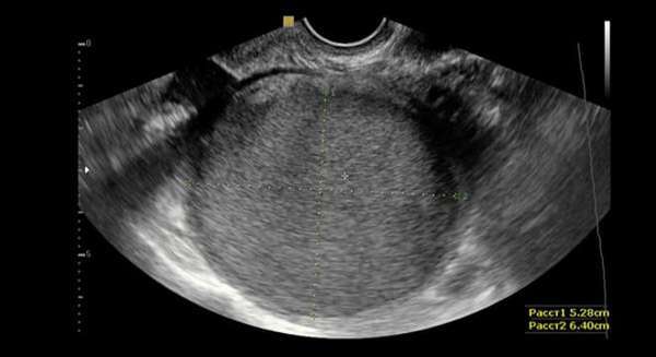 Как выглядит воспаление женских яичников на снимке УЗИ