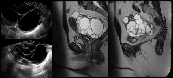 Как выглядит рак яичников на снимке УЗИ