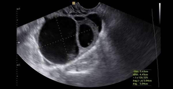 Как выглядит фолликулярная киста яичника на снимке УЗИ