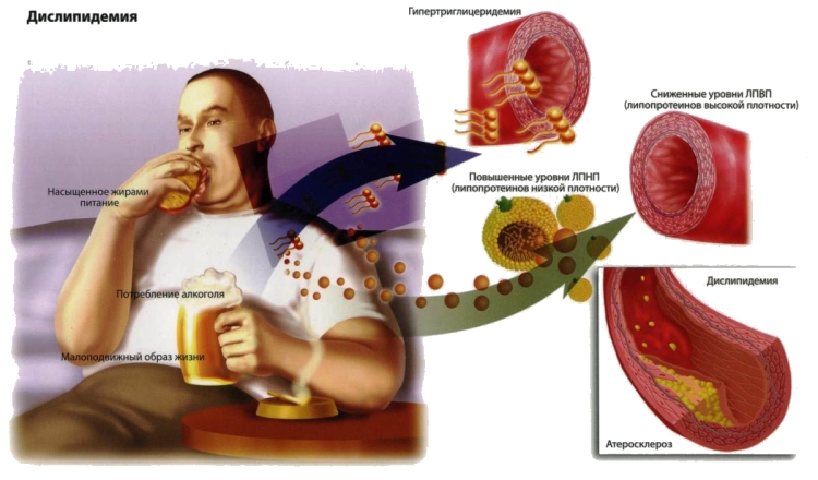 Процесс повышения холестерина в организме мужчины