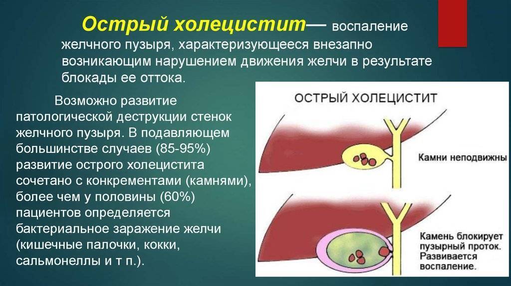 Застой желчи картинка