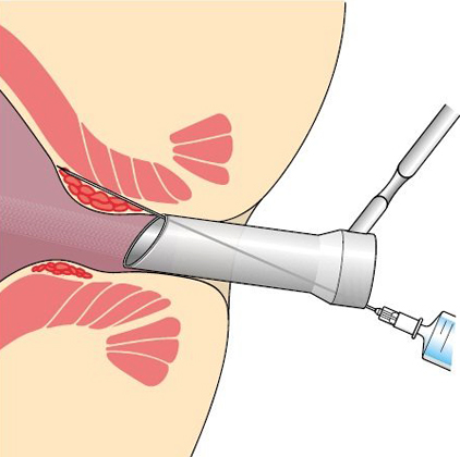 Склерозирование геморроидальных узлов
