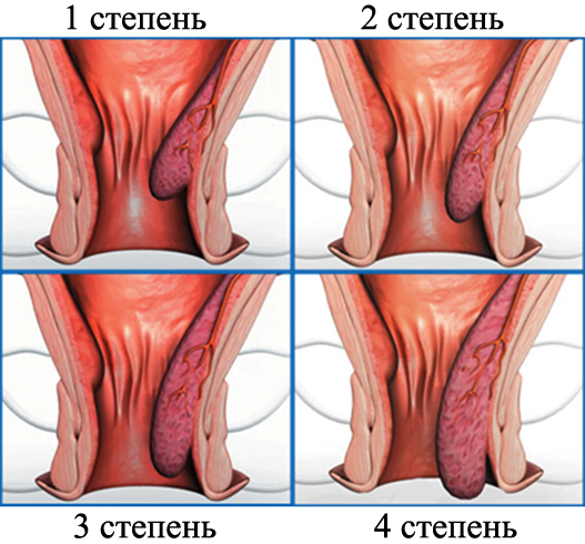 Степени геморроя