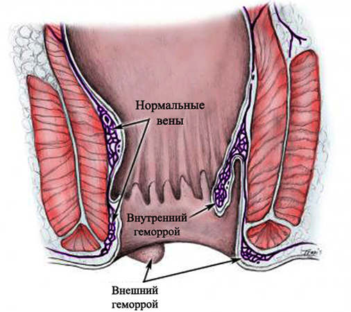 Виды геморроя
