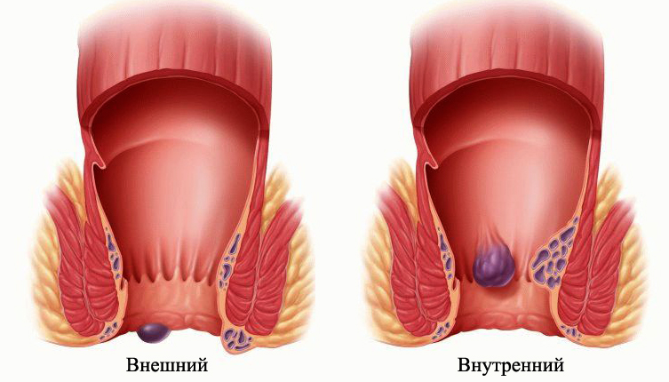 Виды геморроя