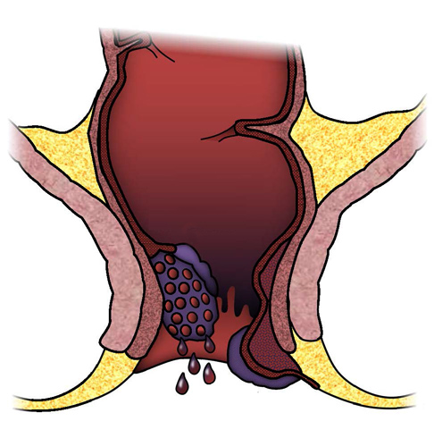 Геморрой кровоточит