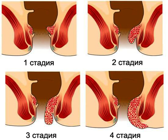 Стадии геморроя