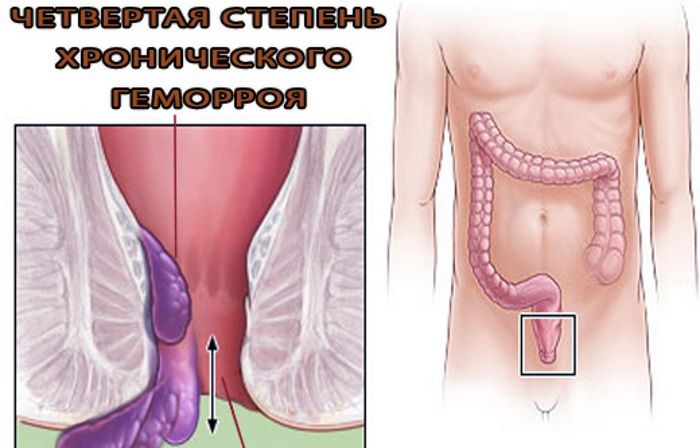 Как лечить геморрой 4 стадии?