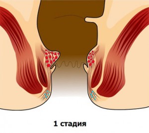 Геморрой 4 стадии причины, лечение с операцией и без