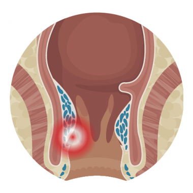 Геморрой 4 стадии причины, лечение с операцией и без