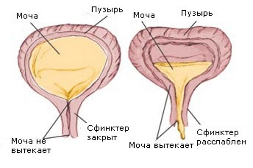 Атония мочевого пузыря симптомы и лечение