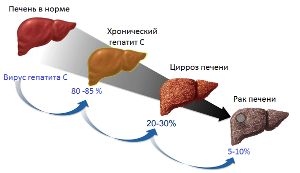 Прогрессирование гепатита С