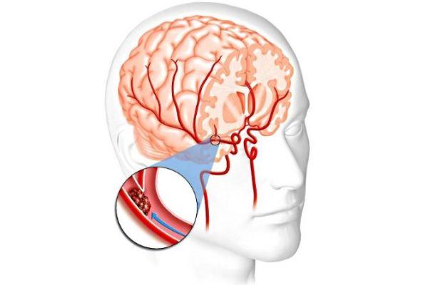 нарушение кровоснабжения мозга