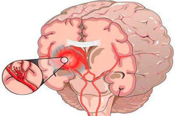 кровоизлияние в мозг
