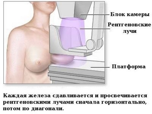 УЗИ молочных желез - когда можно делать, расшифровка, норма, подготовка, на какой день цикла