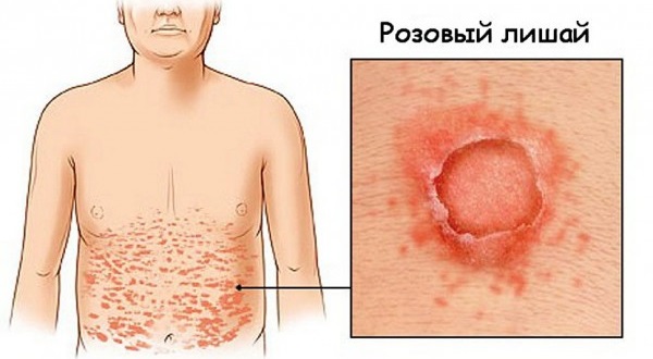 Пятна на коже красного цвета не чешутся, с шелушением и без. Фото на ногах, руках, теле. Что это и как лечить