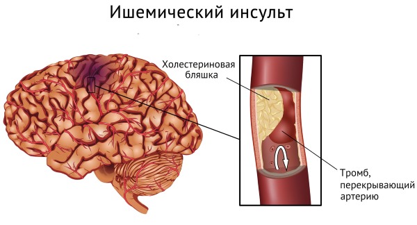 Эритроциты в крови повышены у ребенка: что значит в анализе, симптомы, лечение народными средствами