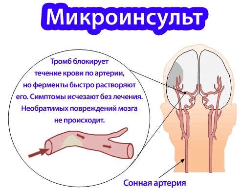 Микроинсульт. Лечение и восстановление, последствия. Первая помощь, лекарства, народные средства