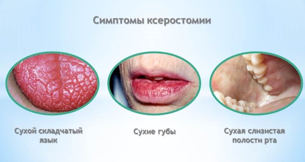 Прединсультное состояние у женщин, мужчин. Первые признаки, основные симптомы. Чем лечить, последствия