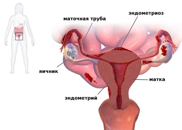 Размеры матки в норме у женщин по УЗИ. Таблица по возрасту, нерожавших, при беременности, после родов, при менопаузе