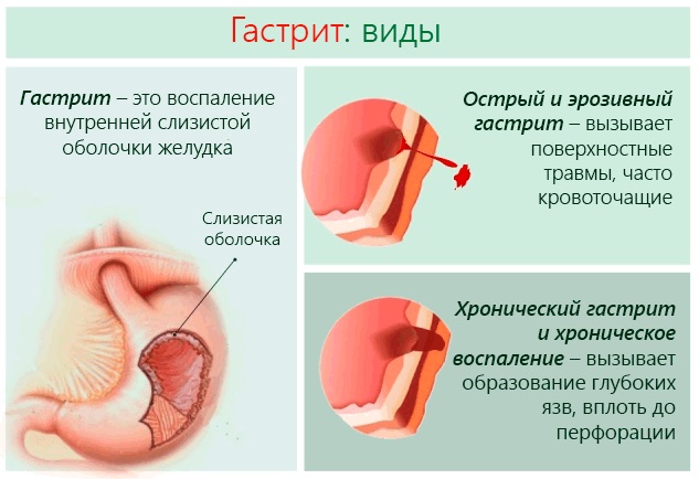 Дискинезия желчевыводящих путей. Симптомы и лечение препаратами, диета, клинические рекомендации для детей, взрослых