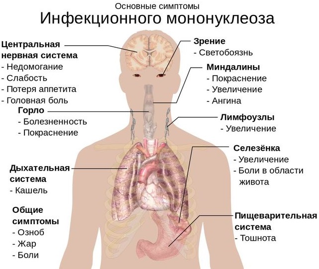 Инфекционный мононуклеоз у взрослых. Симптомы, фото, лечение, рекомендации