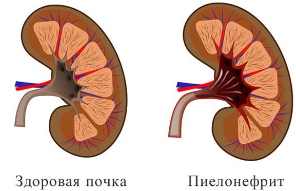 Пиелонефрит у ребенка. Симптомы, лечение. Антибиотики, народные средства