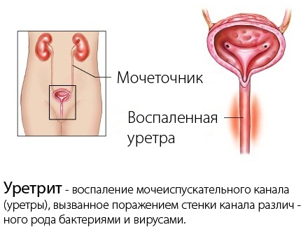 Уретрит у женщин. Как передается, симптомы и лечение народными средствами, антибиотиками, препараты, свечи