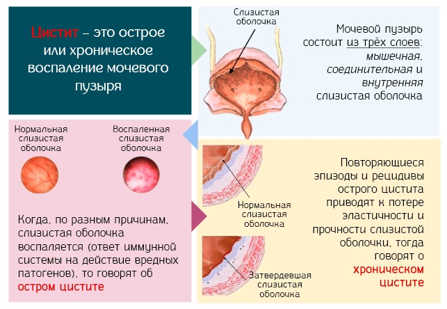 Уретрит у женщин. Как передается, симптомы и лечение народными средствами, антибиотиками, препараты, свечи