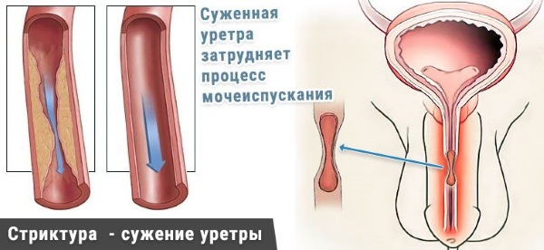 Уретрит у женщин. Как передается, симптомы и лечение народными средствами, антибиотиками, препараты, свечи