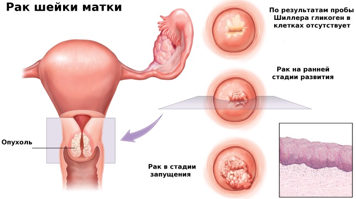 Эпителий в мазке у женщин . Норма в таблице по возрасту, при беременности. Расшифровка анализа