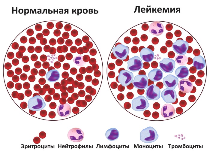 Повышенные лимфоциты в крови у женщин. Причины, норма по возрасту, лечение