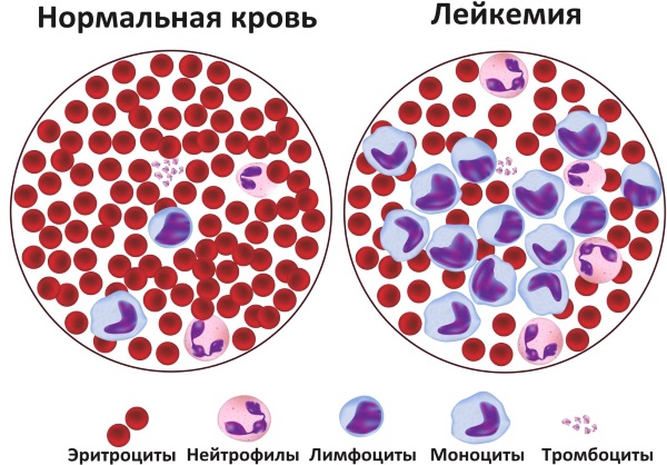 RBC в анализе крови. Что это такое, понижен, повышен, норма у детей, женщин, мужчин