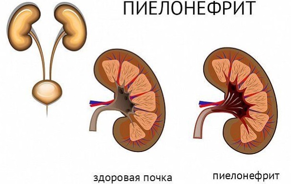 Диета при пиелонефрите почек у женщин. Меню на неделю по дням, что нельзя