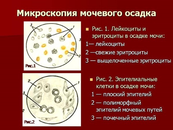 Эритроциты в моче у ребенка. Что это значит, норма, повышенные, неизменные