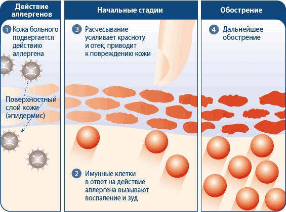 Акридерм гормональный или нет? Чем заменить мазь. Негормональные эффективные препараты аналоги