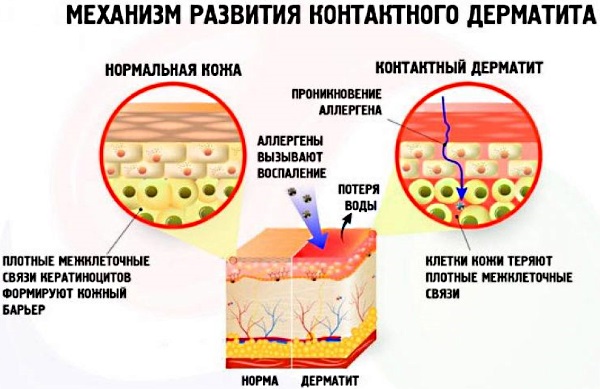 Аллергические высыпания на коже у взрослых. Фото, причины, симптомы, лечение