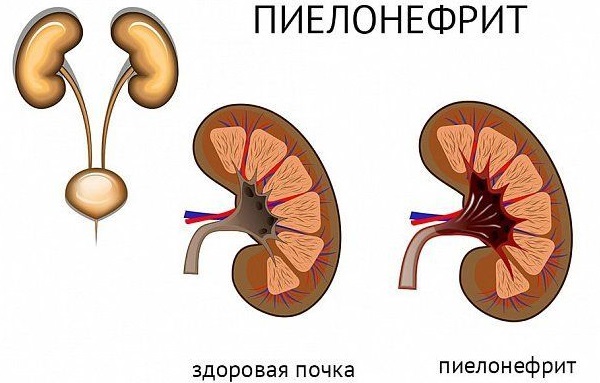 Болезненное мочеиспускание у женщин частое, в конце, с кровью. Причины и лечение