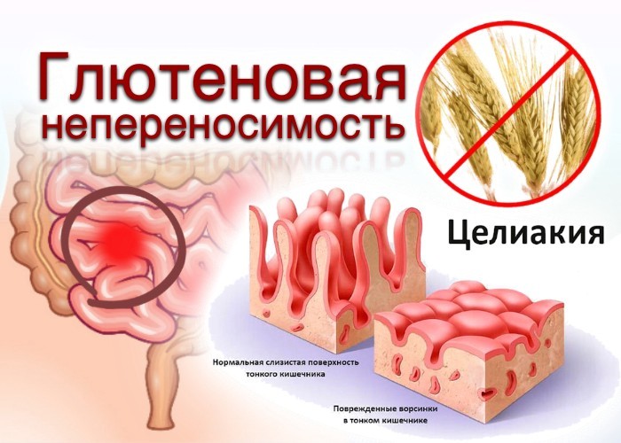 Нехватка железа в организме у женщин. Причины, симптомы и лечение