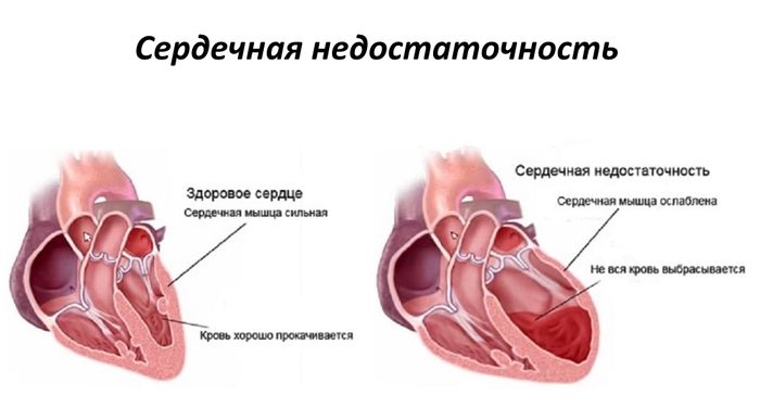 Нехватка железа в организме у женщин. Причины, симптомы и лечение