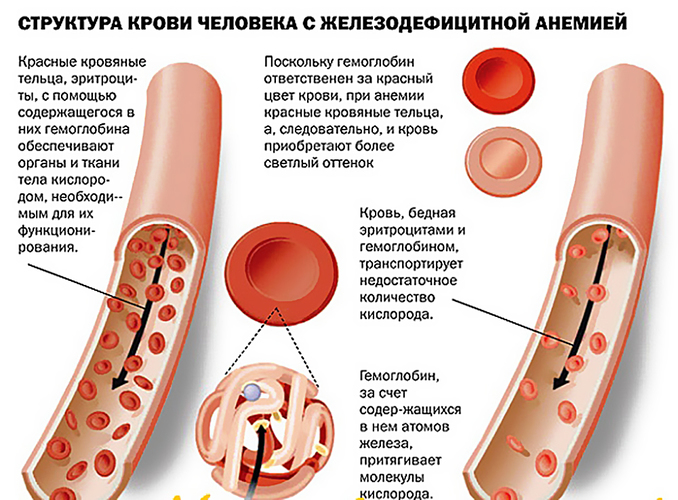 Нехватка железа в организме у женщин. Причины, симптомы и лечение