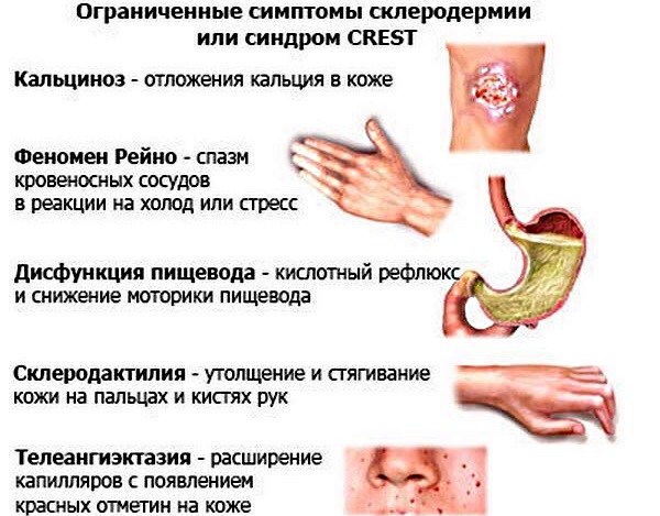Склеродермия. Признаки заболевания, фото, лечение, клинические рекомендации