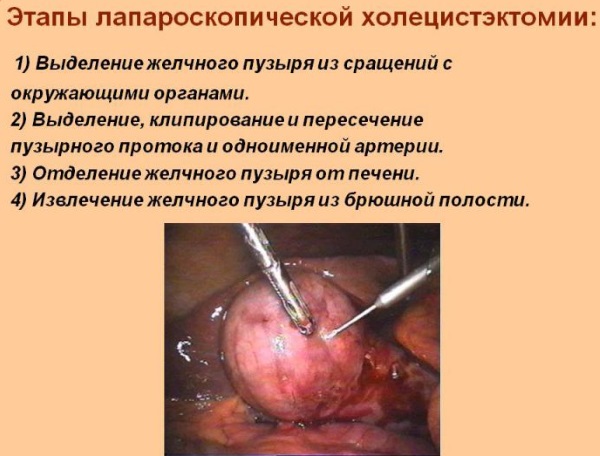 Застой желчи. Симптомы и лечение у взрослых народными средствами, препаратами