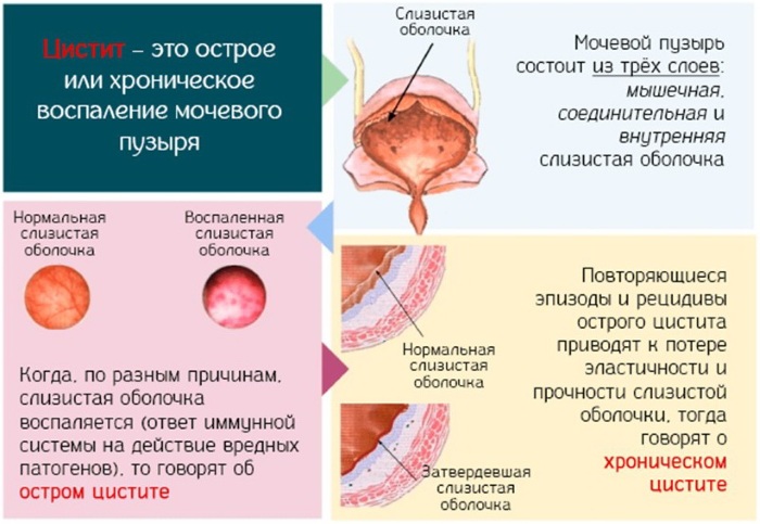 Мочевой пузырь. Болезни, симптомы, строение, признаки заболеваний, лечение